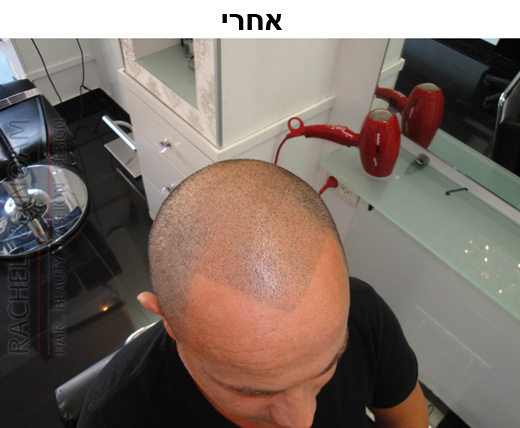 לפני ואחרי הדמיית זקיקי שיער בהרצליה
